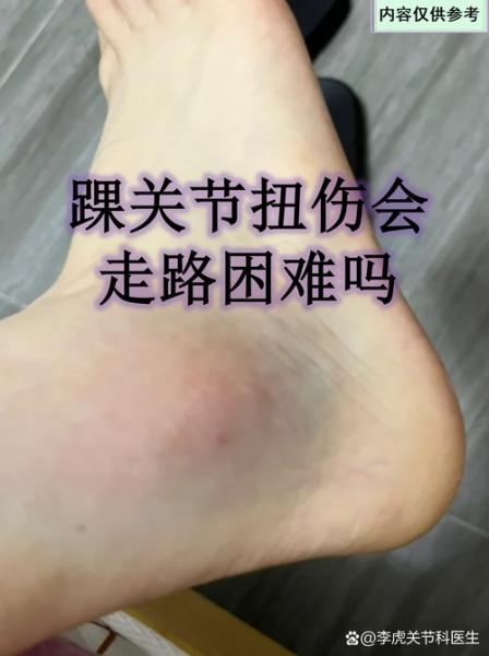 同曦官方：林葳脚踝距腓前韧带轻微撕裂康复期预计为12周